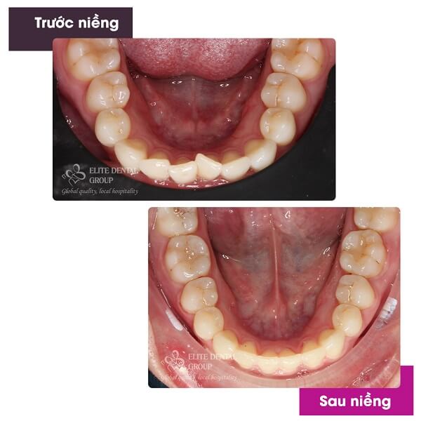 Hình chụp răng trước và sau khi niềng răng