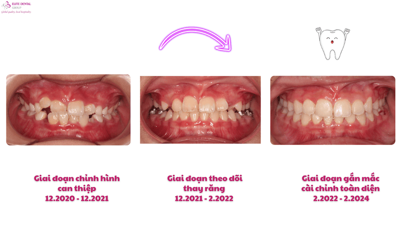 Hình ảnh tình trạng răng miệng 4