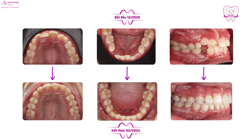 Hình ảnh tình trạng răng miệng 5