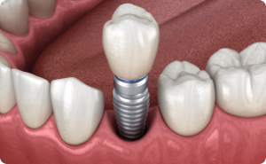 Dịch vụ trồng 1 răng Implant