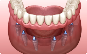 Dịch vụ trồng răng Implant toàn hàm