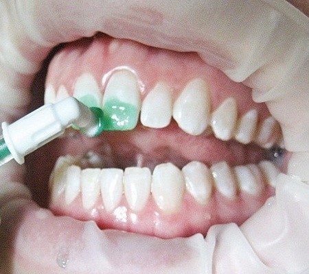 Điều trị đốm trắng răng bằng ICON