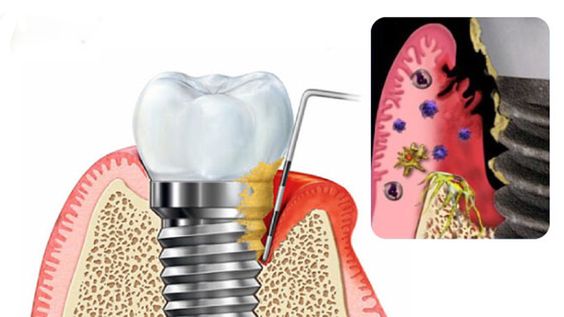 Hình minh họa tình trạng viêm quanh Implant