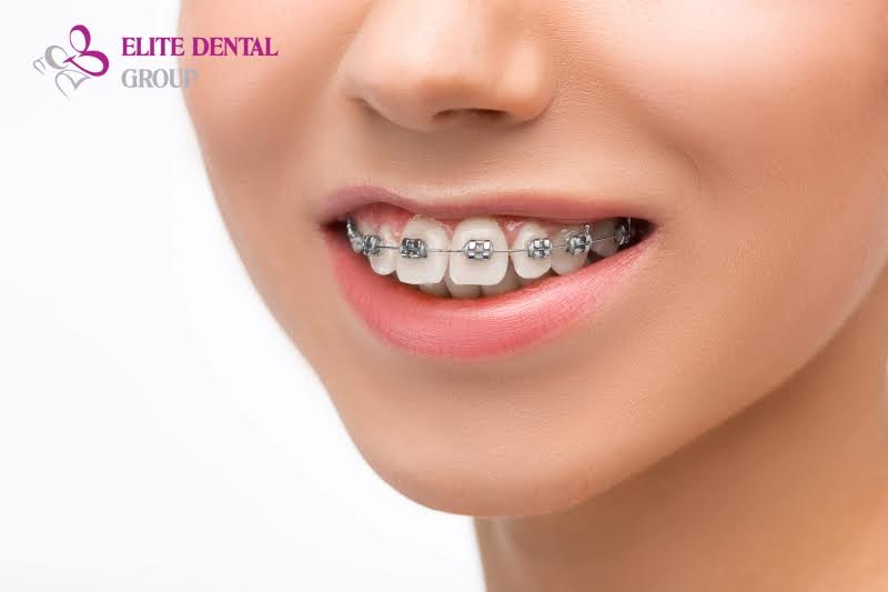 Các loại niềng răng mắc cài