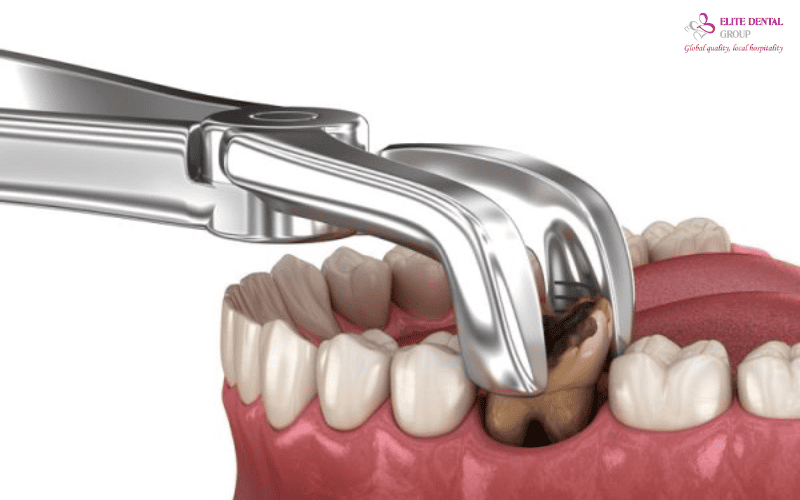 Các trường hợp chống chỉ định nhổ răng