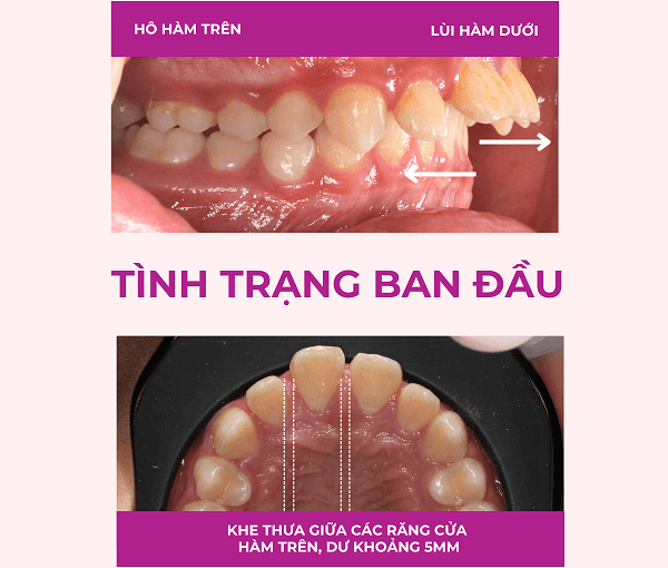 Câu chuyện khách hàng Trần Đăng Minh Huy