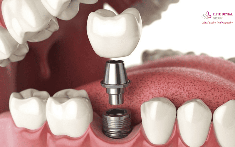 Có thể áp dụng phương pháp trồng răng Implant để cải thiện tình trạng mất răng