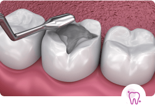 Trám Răng Thẩm Mỹ