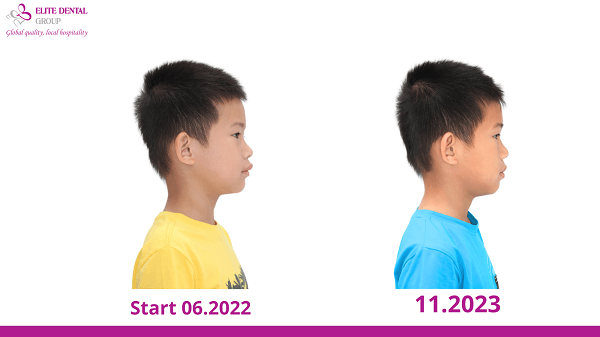 Hình ảnh trước và sau khi điều trị Lữ Tấn Hùng
