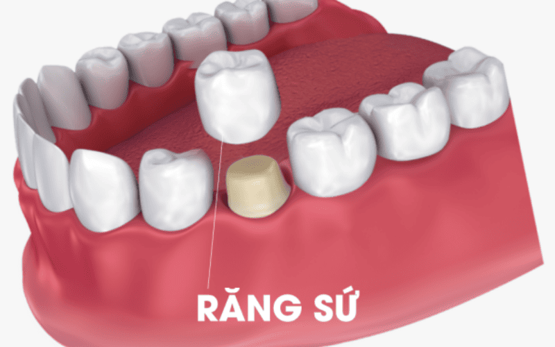 Phương pháp bọc răng sứ