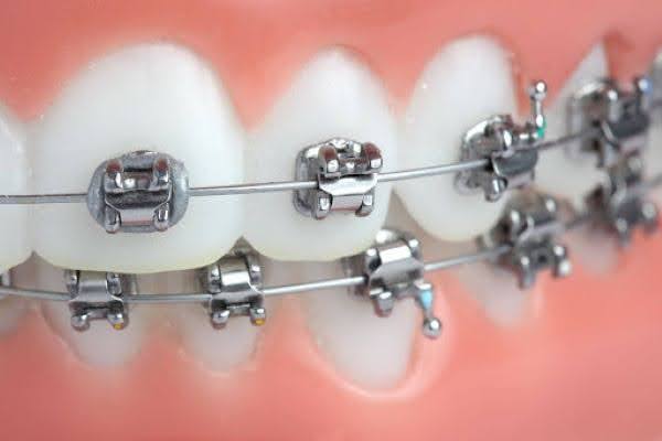 Niềng răng mắc cài kim loại tự buộc