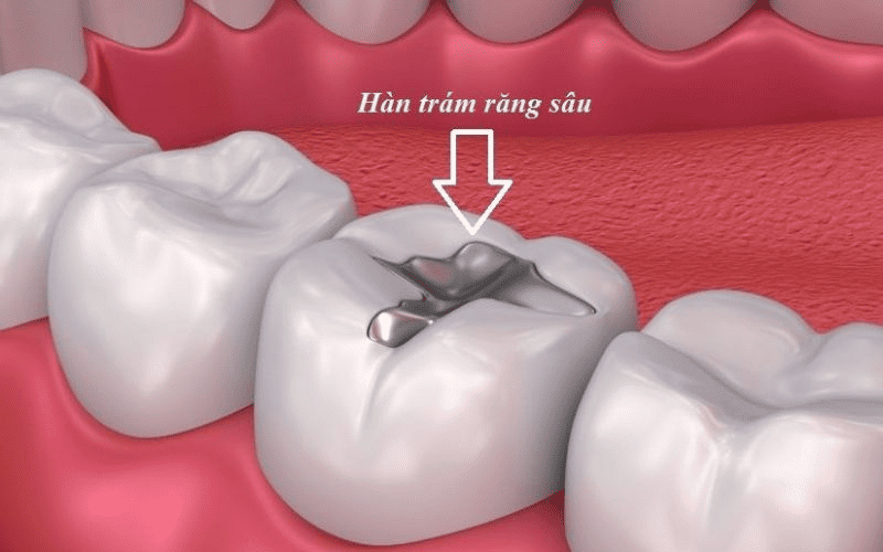 Phương pháp trám răng tại Elite
