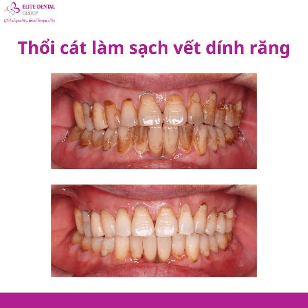 Kết quả điều trị bằng phương pháp thổi cát 