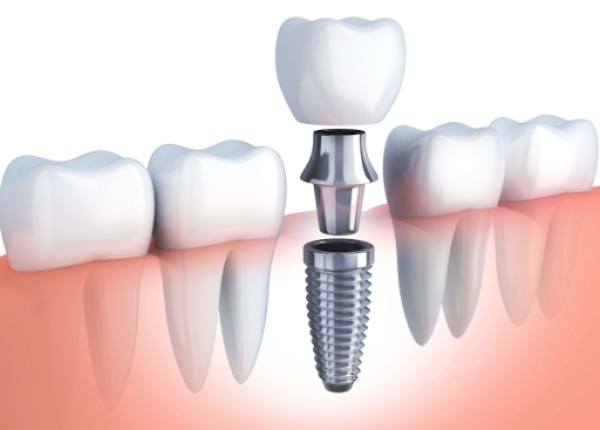 trồng răng có được hưởng bảo hiểm y tế không