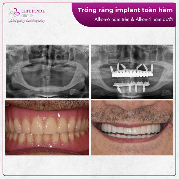 Hình chụp phim trước và sau khi cấy ghép Implant