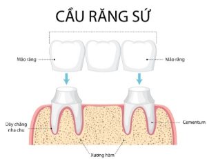 nhược điểm của cầu răng sứ