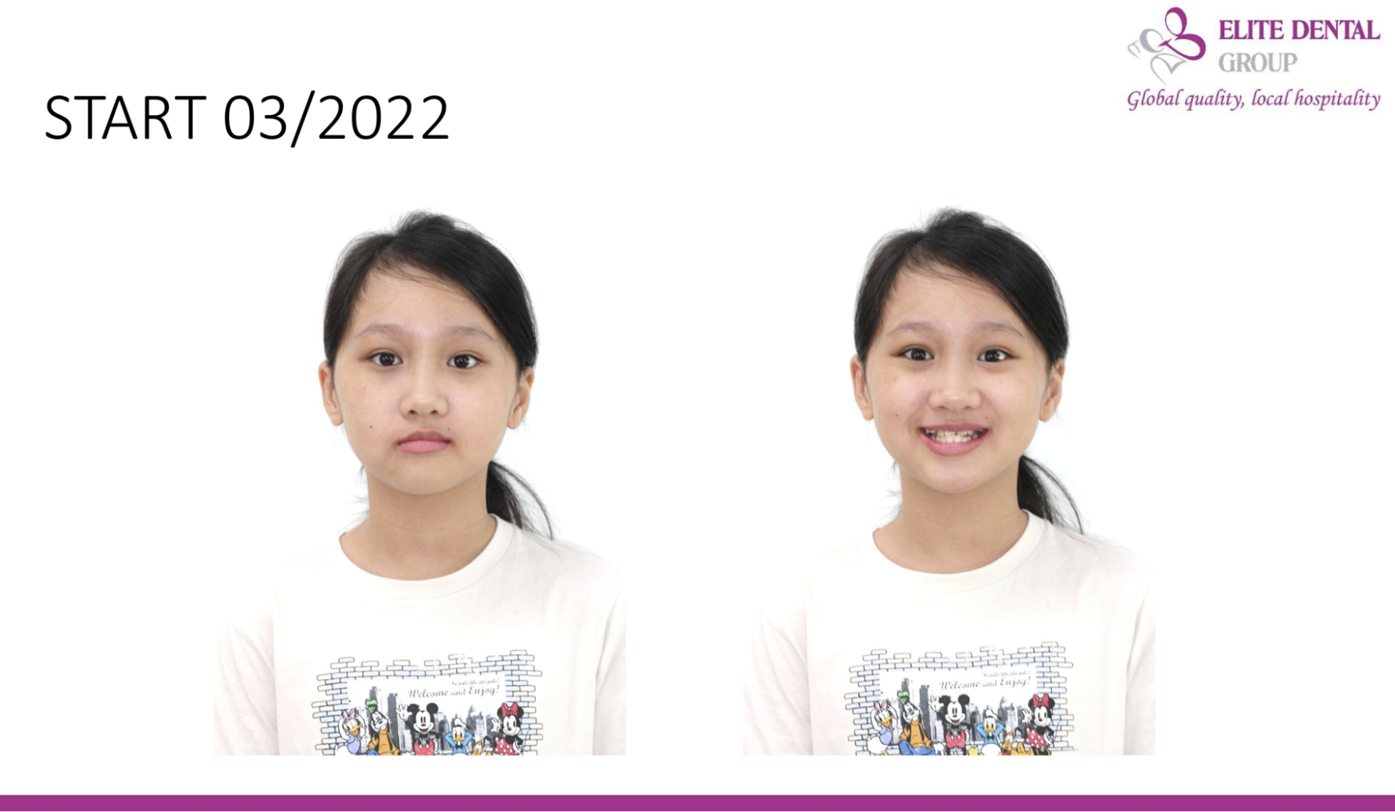 Gương mặt cô bé lệch khá rõ, miệng mất cân xứng.
