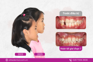 Bé Thiên Ân điều trị chỉnh tra