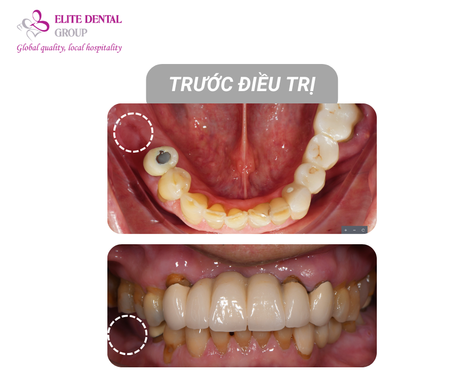 Nhân duyên đưa cô chú đến Elite Dental