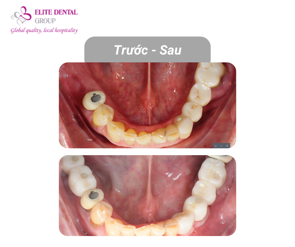 Kế hoạch điều trị Implant của cô chú Văn Toại