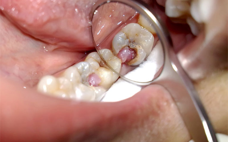 Tình trạng răng miệng trở nên nghiêm trọng khi điều trị sai cách