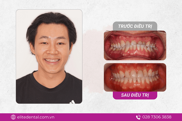 Elite Dental luôn chú trọng đến kết quả bền vững