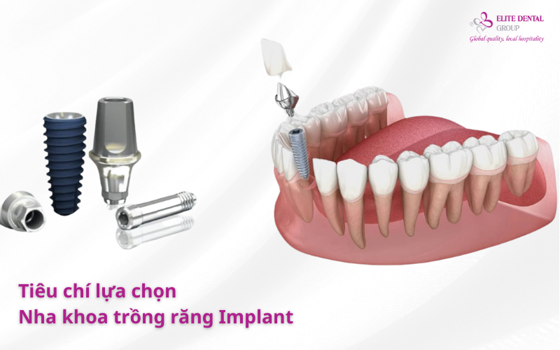 Tiêu chí lựa chọn Nha khoa Trồng răng Implant uy tín