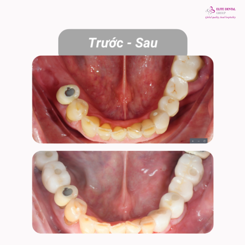 Hình ảnh trồng răng Implant của Chú Norman Văn Toại
