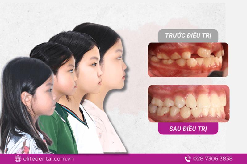 Quá trình điều trị giúp cho Quỳnh Anh tự tin hơn trong giao tiếp