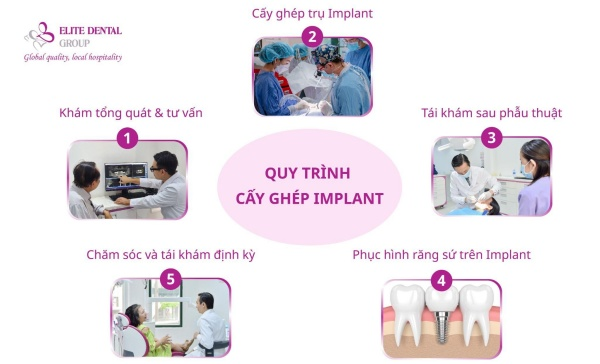 Quy trình dịch vụ tại Elite Dental chuẩn nha khoa, nghiêm ngặt