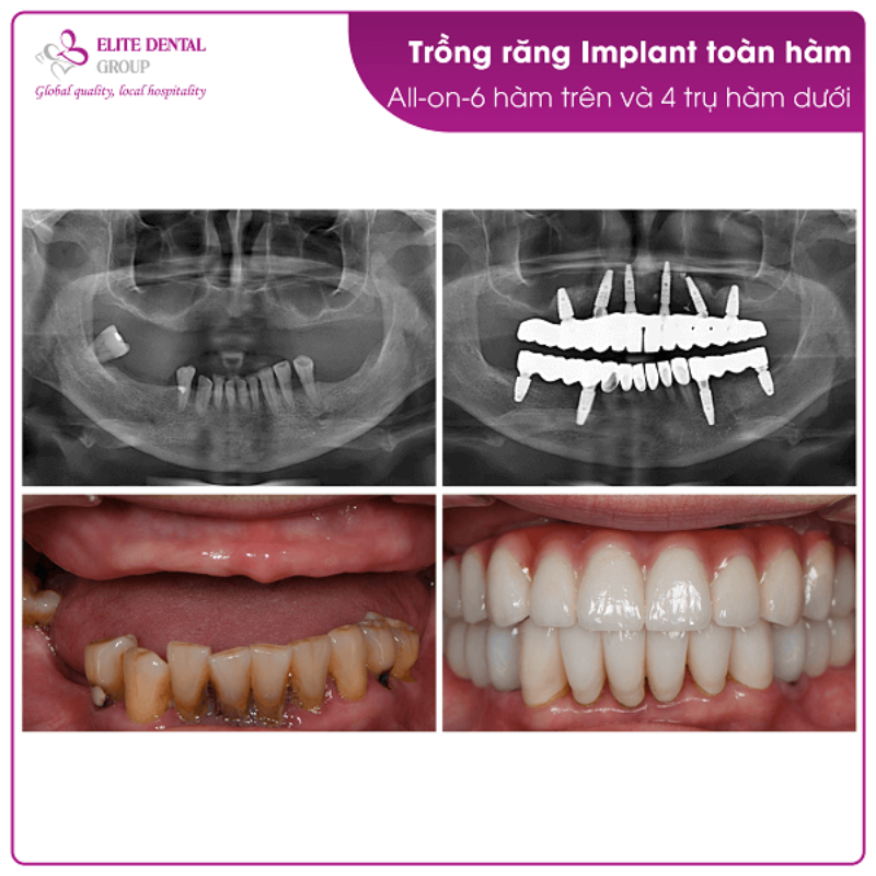 Dịch vụ trồng răng Implant chất lượng
