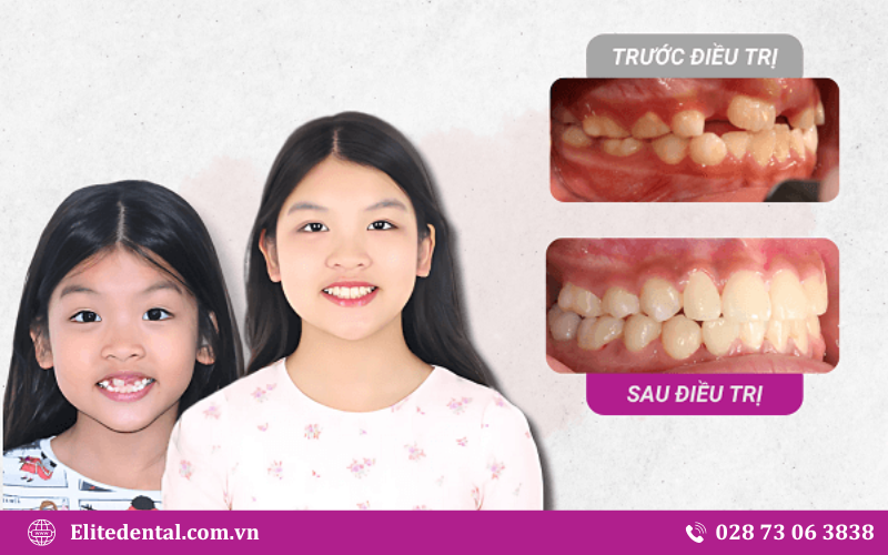 Elite Dental nổi bật với dịch vụ chỉnh nha