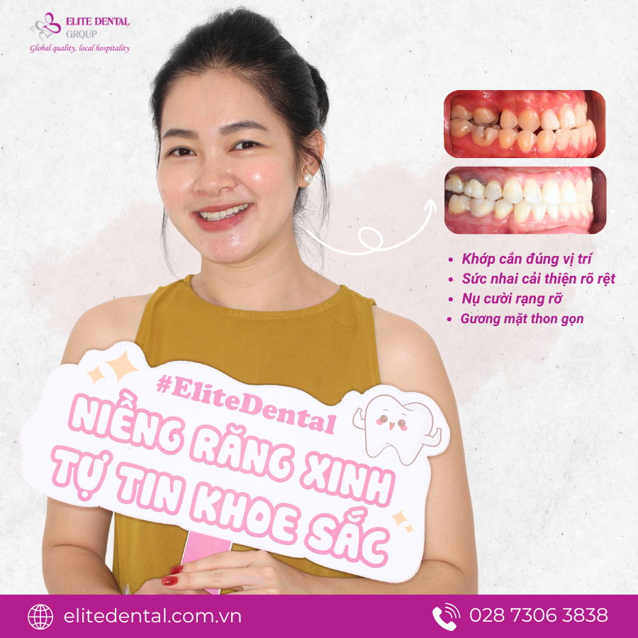 Chị Lâm Thư ngày kết thúc niềng răng.