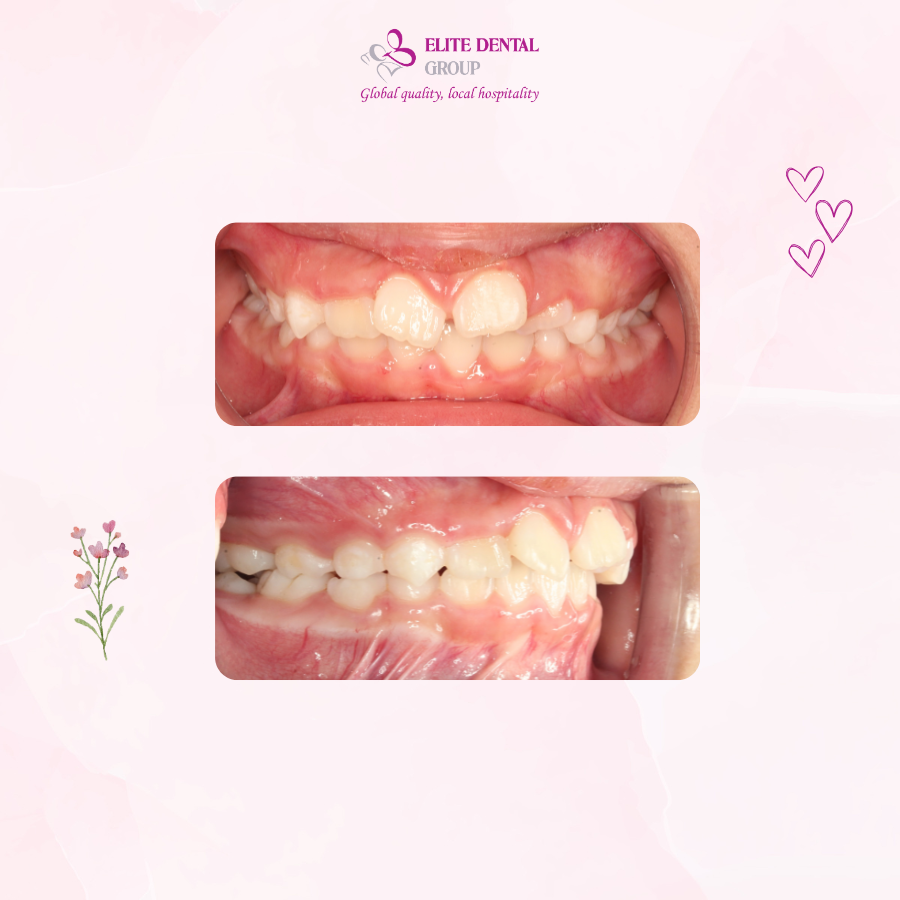 Tình trạng răng ban đầu của bé Minh Sa - con gái chị Lâm Thư