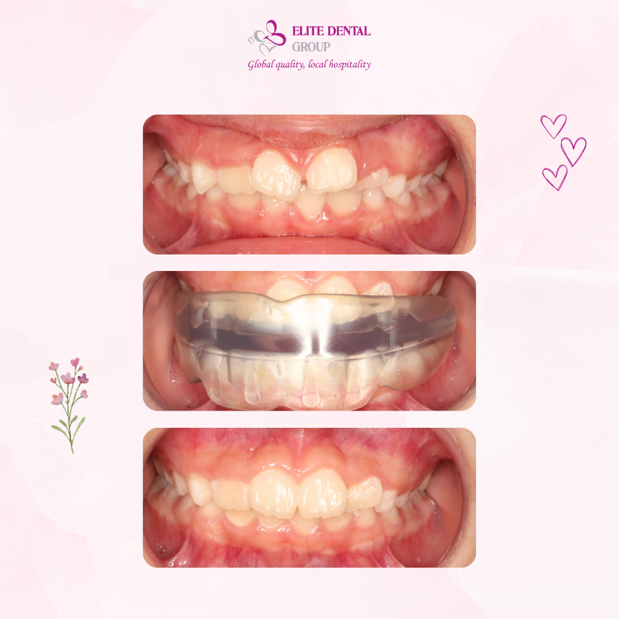 Sự thay đổi sau 1 năm mang khí cụ EF của bé Minh Sa, hai răng cửa mọc xoay trở về vị trí đúng