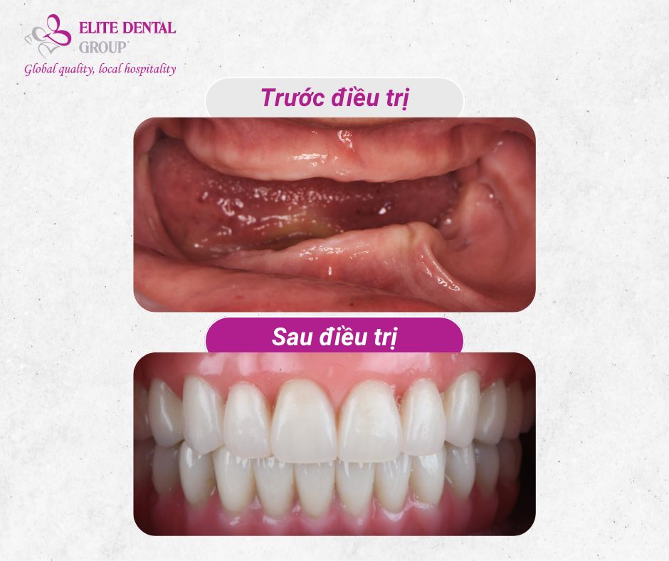 Tình trạng trước và sau trồng răng Implant All - On - 4 của cô Nga 