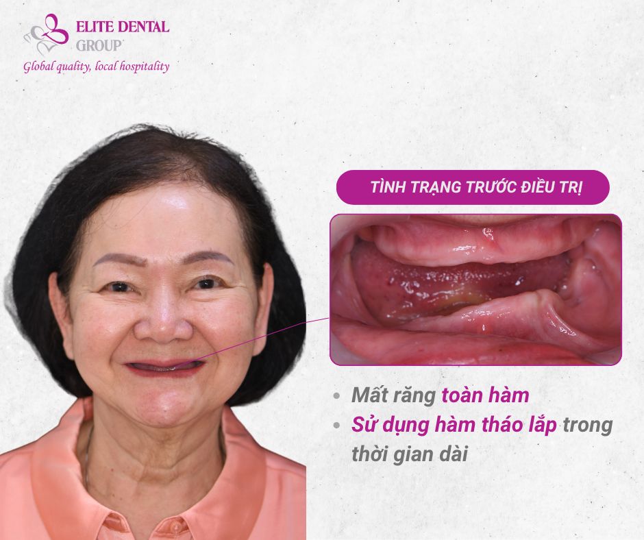 Tình trạng mất răng toàn hàm của cô Nga và sự bất tiện của hàm giả tháo lắp