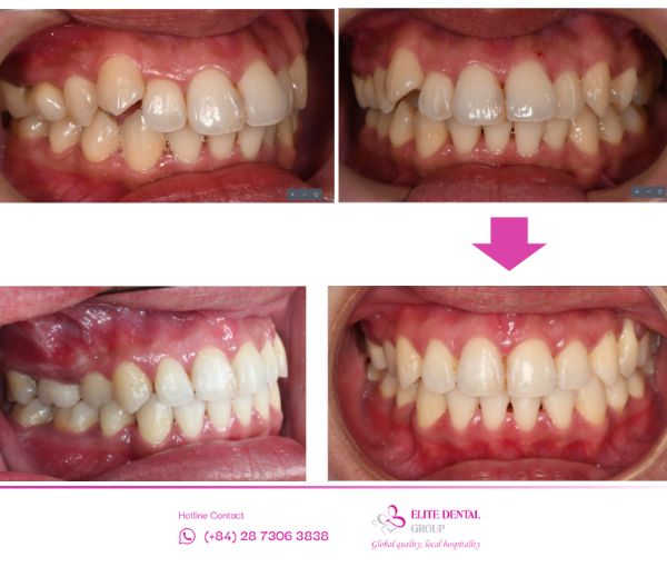 Chi phí cũng là yếu tố ảnh hưởng đến hiệu quả niềng răng hô - Hình ảnh 1 ca niềng răng trong suốt Invisalign thành công tại Elite Dental