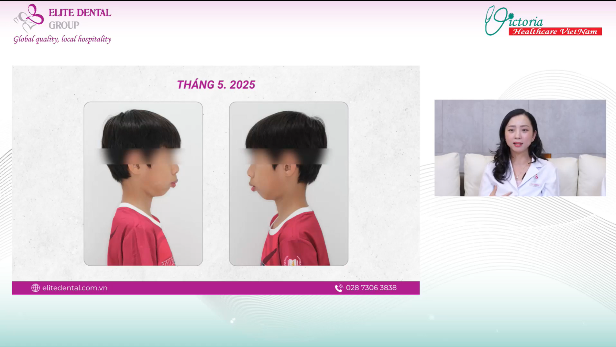 Đừng xem nhẹ thở miệng ở trẻ