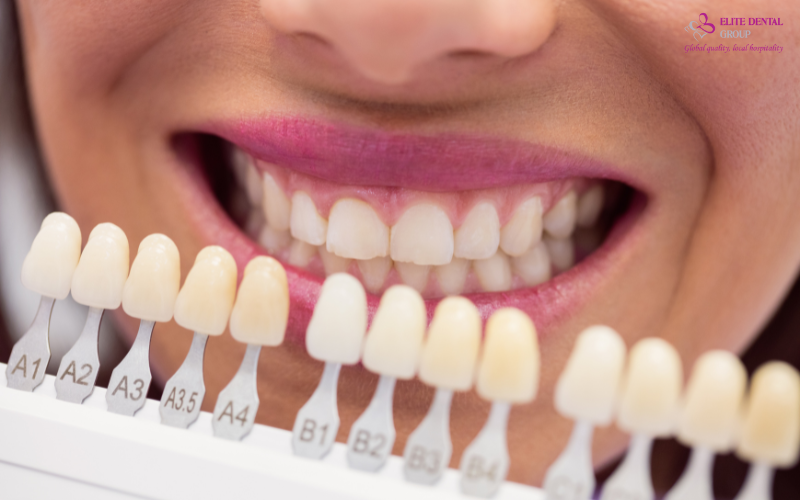 Dán sứ veneer là phương pháp được nhiều người lựa chọn