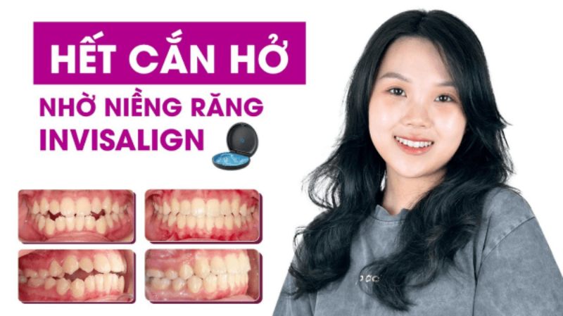 Cải thiện chức năng ăn nhai nhờ phương pháp niềng răng Invisalign