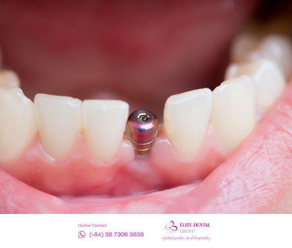 Trồng răng Implant tại Elite Dental áp dụng tiêu chuẩn điều trị quốc tế.