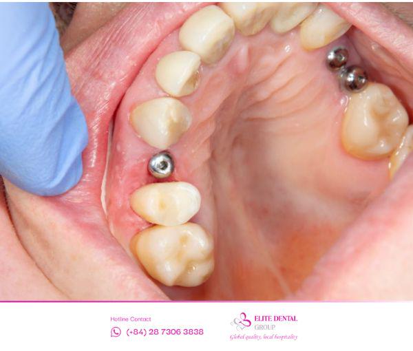 Đội ngũ bác sĩ tại Elite Dental mang lại sự an tâm nhờ tay nghề chuyên môn cao và sự tận tâm trong điều trị Implant.