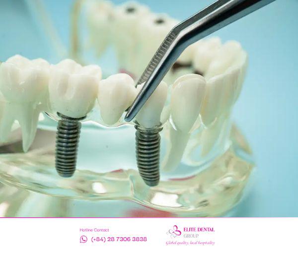 Tìm hiểu quy trình cấy ghép Implant chuẩn y khoa tại Elite Dental.