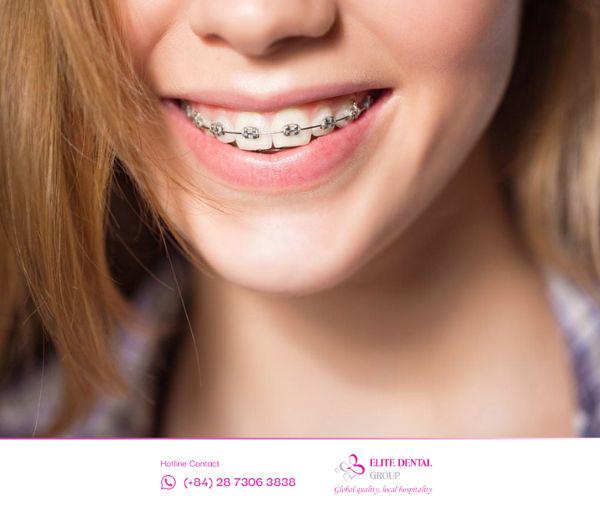 Tìm hiểu quy trình niềng răng diễn ra như thế nào?