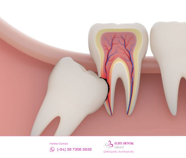 Răng khôn mọc ngang cần được xử lý để tránh các biến chứng về lâu dài