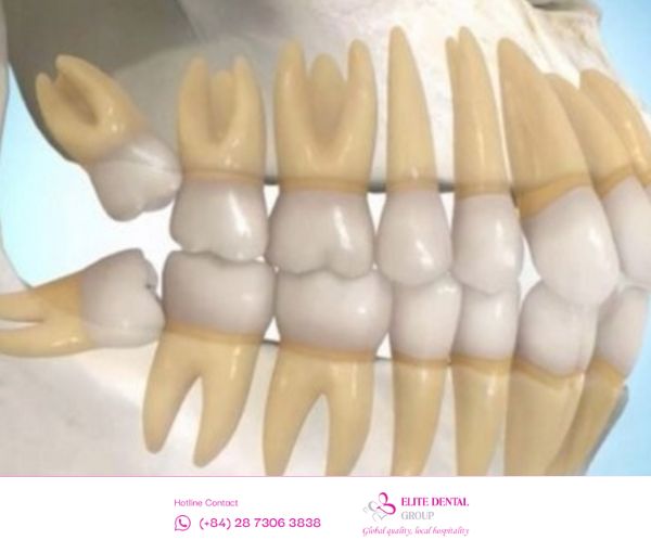 Bạn cần loại bỏ răng khôn mọc ngang đúng lúc và kịp thời.