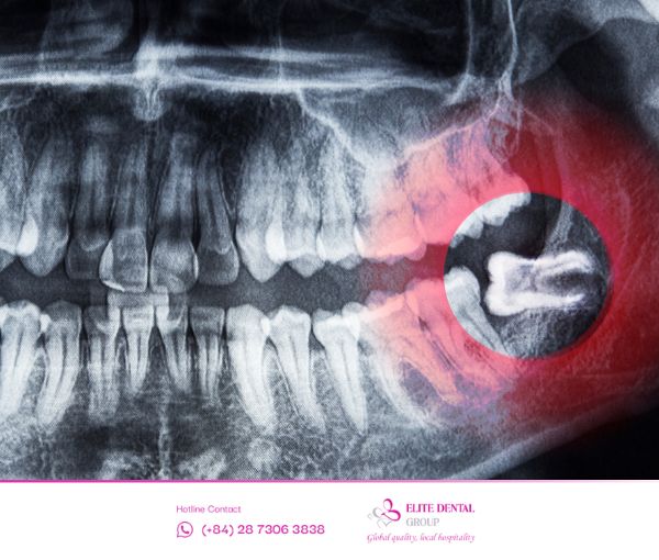 Răng khôn mọc ngang sẽ gây đau nhức khó chịu cho bạn.
