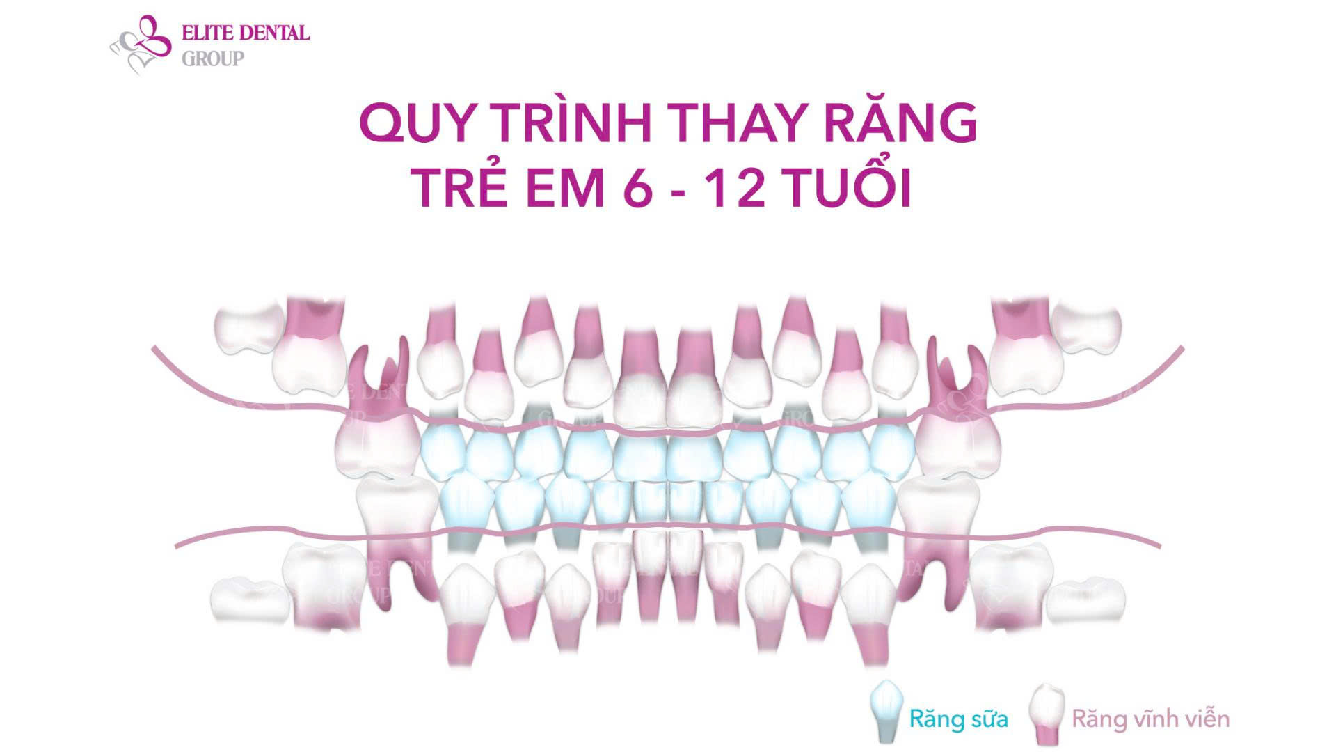 Giai đoạn thay răng ở trẻ thường diễn ra từ 6 - 12 tuổi