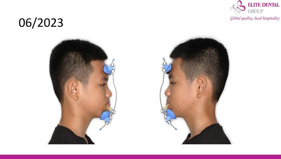 Giai đoạn chỉnh xương với khí cụ